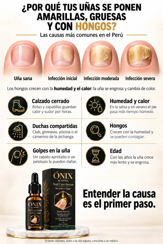 Por qué las uñas se ponen amarillas